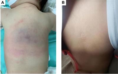 Case Report: Kaposiform hemangioendothelioma with PIK3CA mutation successfully treated with sirolimus